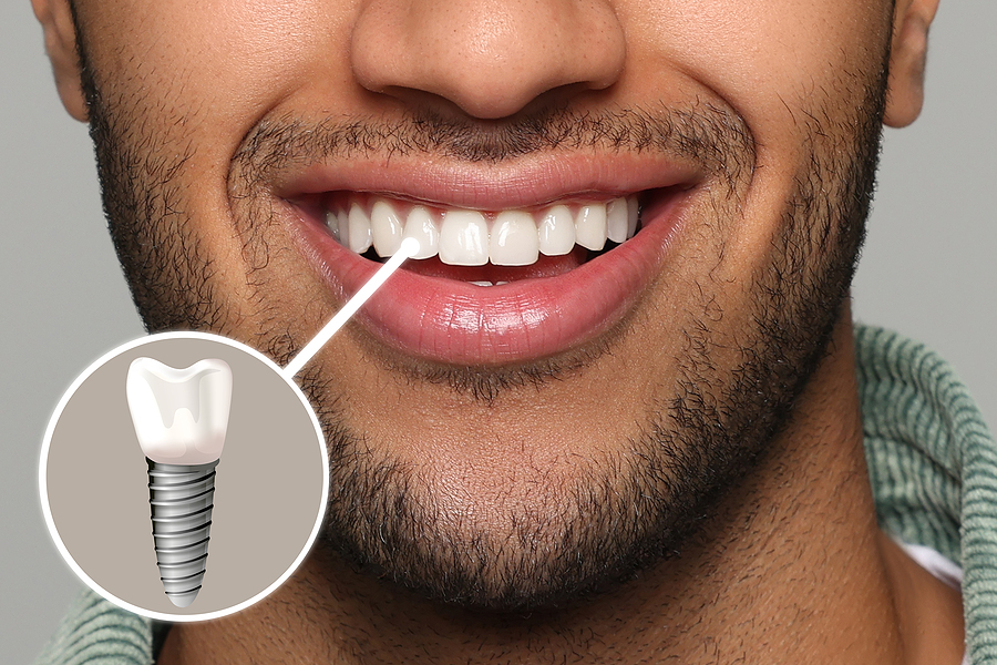 Dental Implants So Good You Can't Tell That Is Not a Real Tooth